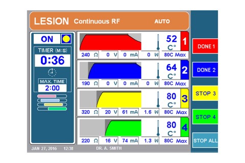 URF-3AP + MLA-4 Lesion Continuous RF Staggered Starts