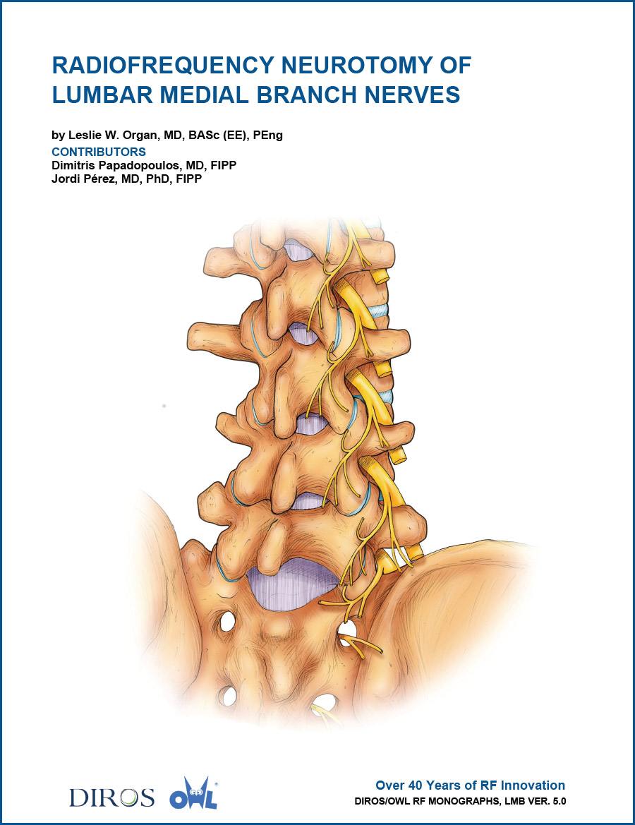 Radiofrequency Neurotomy of Lumbar Medial Branch Nerves