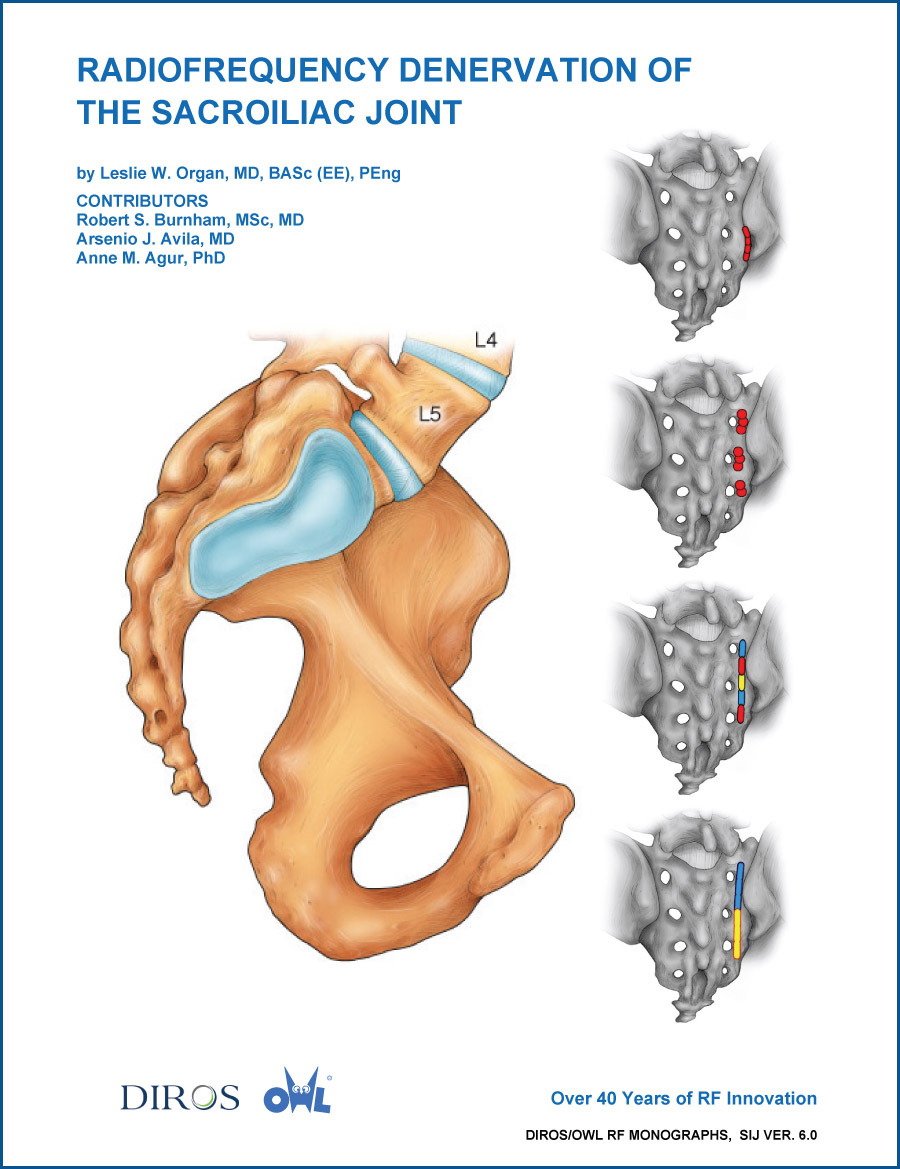 Radiofrequency Denervation of the Sacroiliac Joint